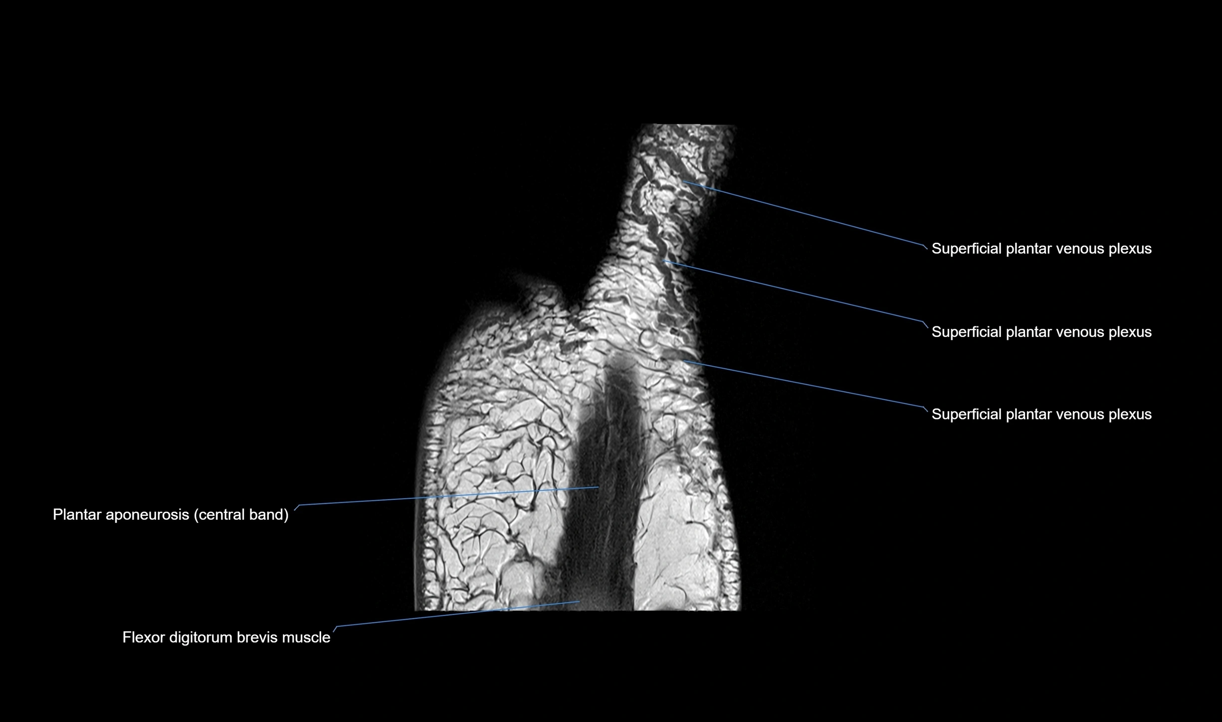 MRI mid foot coronal ligaments cross sectional anatomy 3T  radiology  image-img-00001-00040.webp